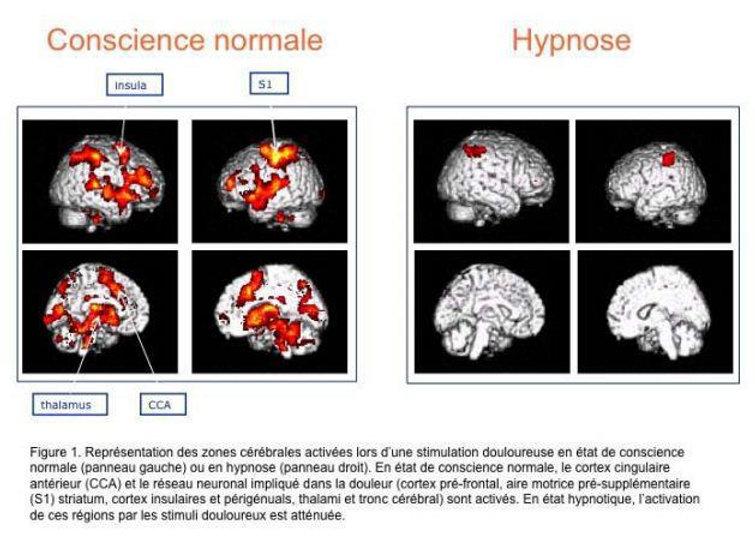 Imagerie cérébrale (IRM fonctionnelle) des zones activées par une stimulation douloureuse : nombreuses régions activées en état de conscience normale (insula, S1, thalamus, cortex cingulaire antérieur), activation nettement atténuée sous hypnose